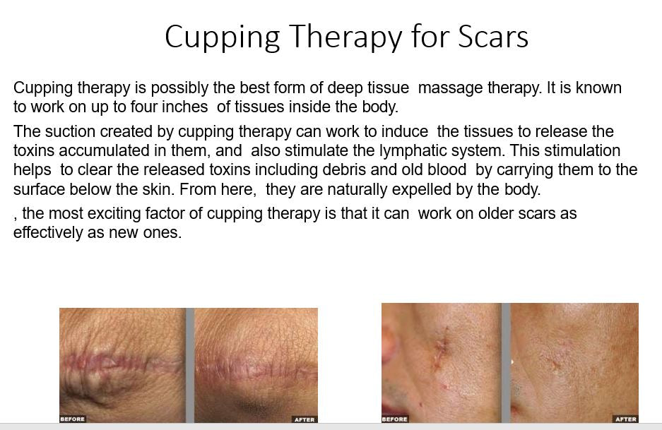 
                  
                    Introduction to Cupping 2.0 CEs NCBTMB approved
                  
                