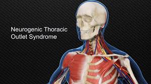 
                  
                    Thoracic Outlet Syndrome 1.0 CEs
                  
                