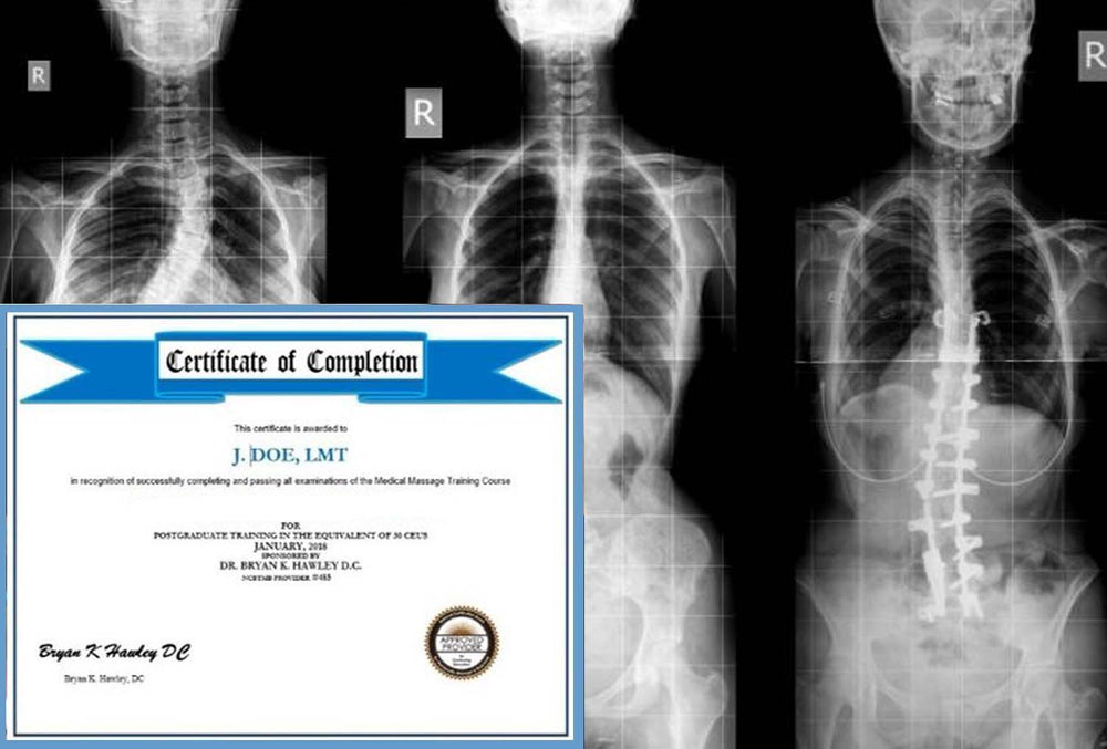 
                  
                    Scoliosis an in depth study 1.0 CEs
                  
                